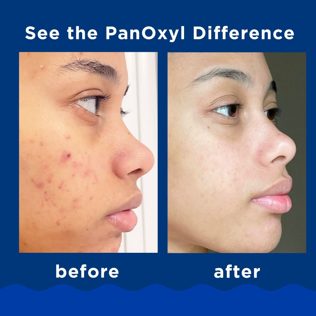 غسول رغوي لحب الشباب من بانوكسيل (بنزويل بيروكسايد 10%) - أقصى قوة | PanOxyl Acne Foaming Wash, Maximum Strength 10% Benzoyl Peroxide 165 مل - EROS STORE