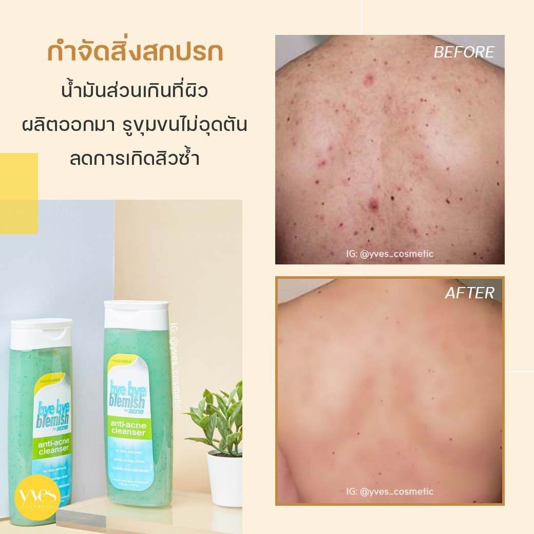 منظف الوجه والجسم المضاد لحب الشباب من باي باي بليمش | Bye Bye Blemish Acne Cleanser 236 مل - EROS STORE