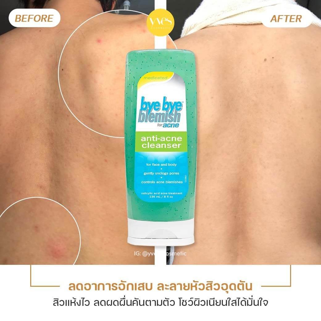 منظف الوجه والجسم المضاد لحب الشباب من باي باي بليمش | Bye Bye Blemish Acne Cleanser 236 مل - EROS STORE